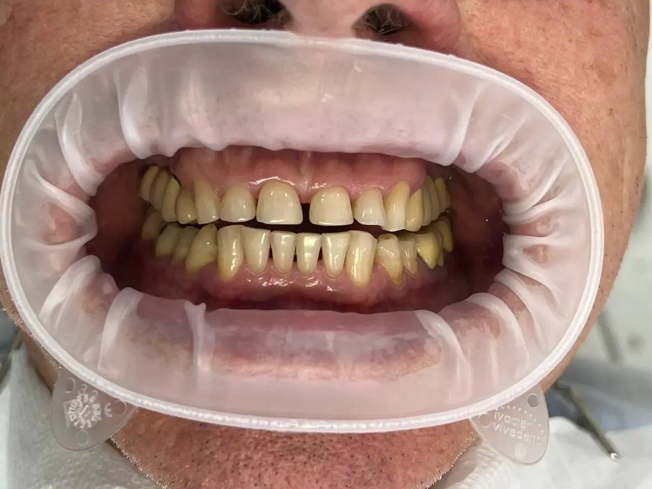 Caso clínico de lentes de contato dental: registro inicial do sorriso