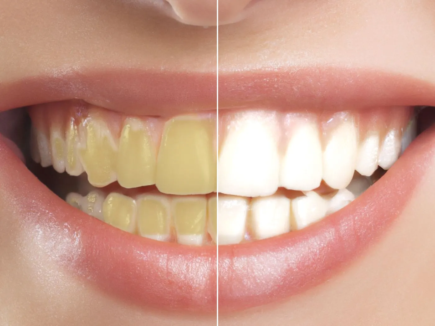 Comparação ilustrativa do tom dos dentes com e sem clareamento profissional