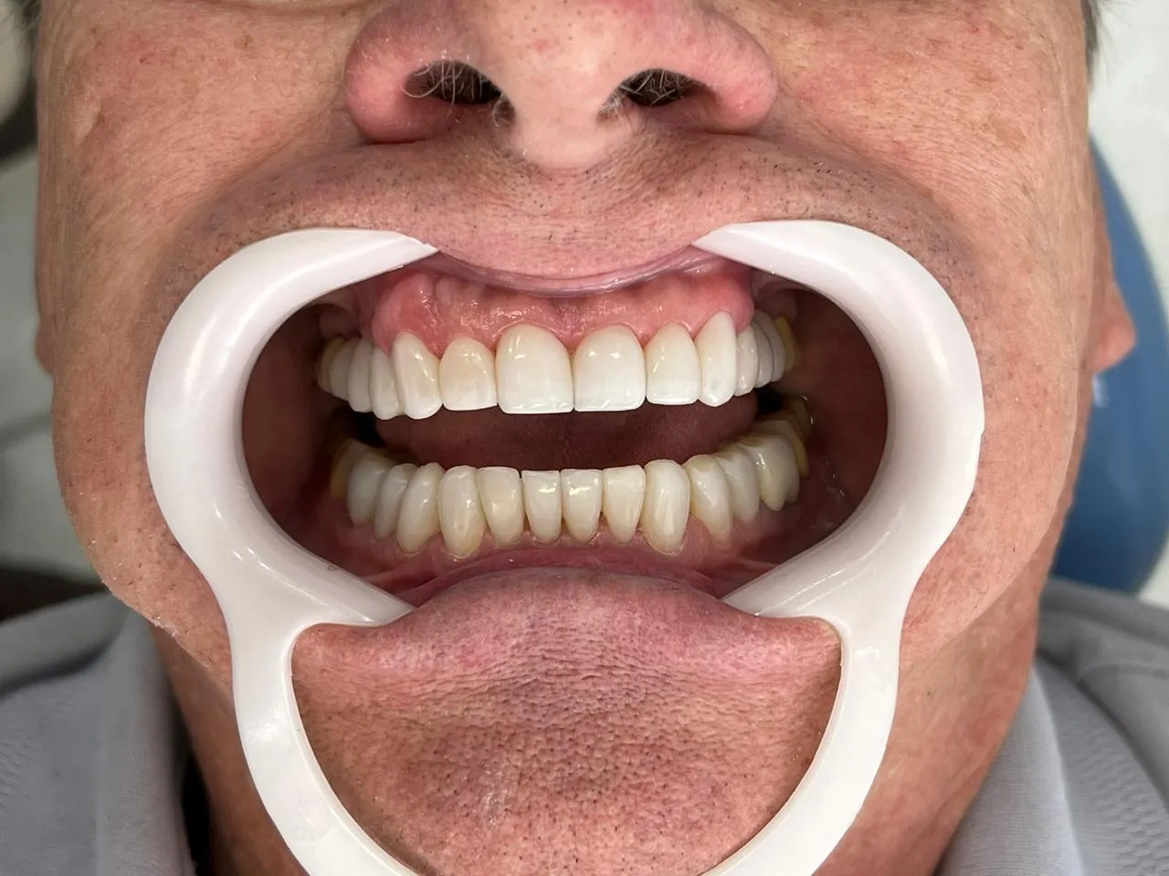 Caso clínico de lentes de contato dental: resultado final do tratamento