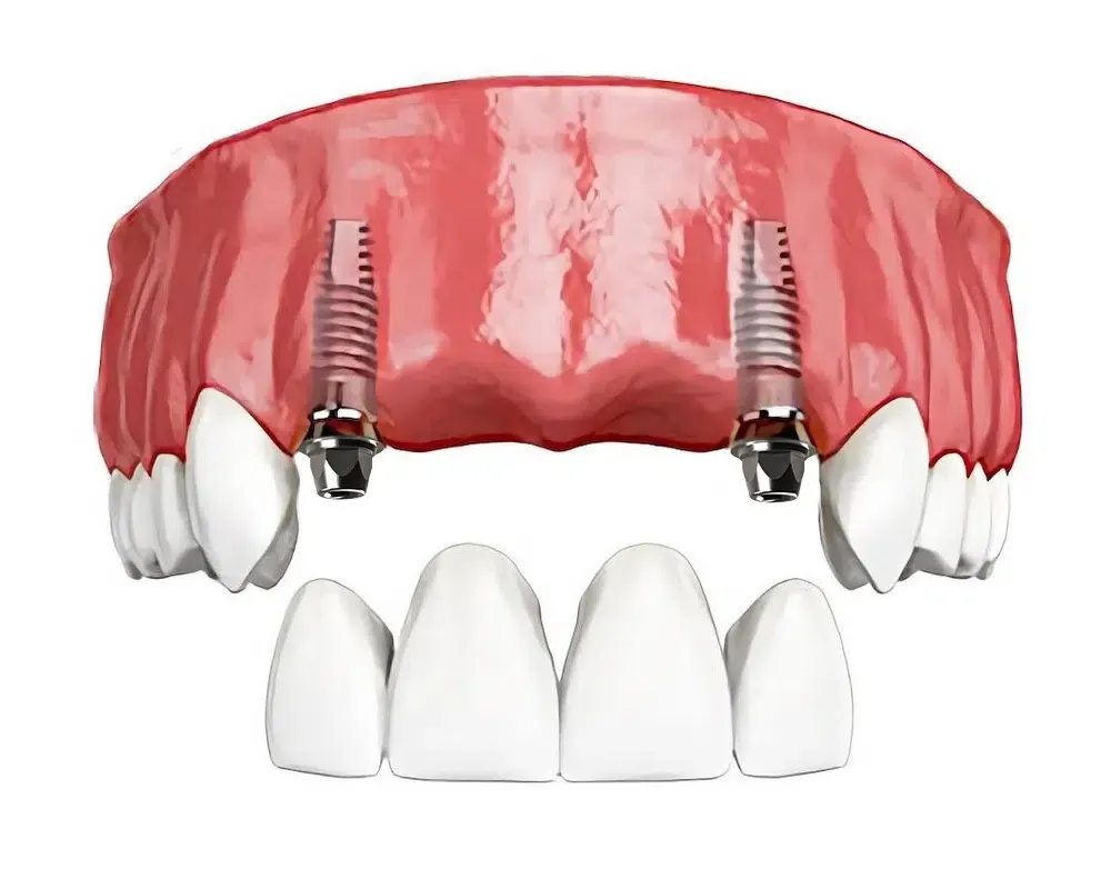 Ilustração de prótese fixa de quatro dentes sustentada por dois implantes
