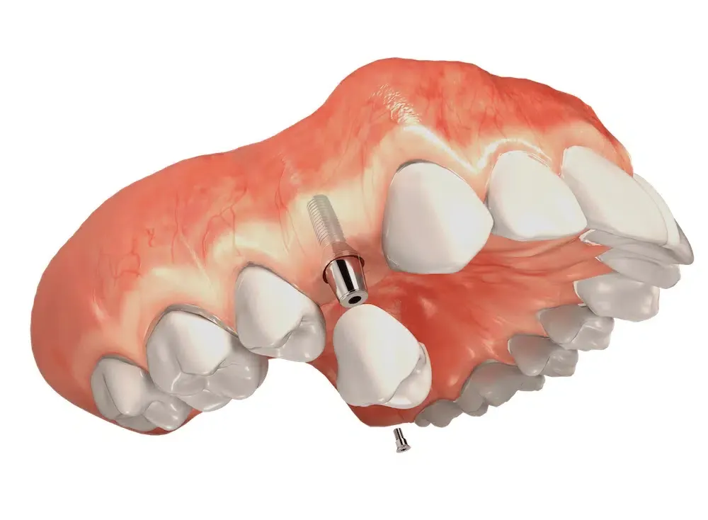 Ilustração de implante dentário com pino de titânio na arcada superior