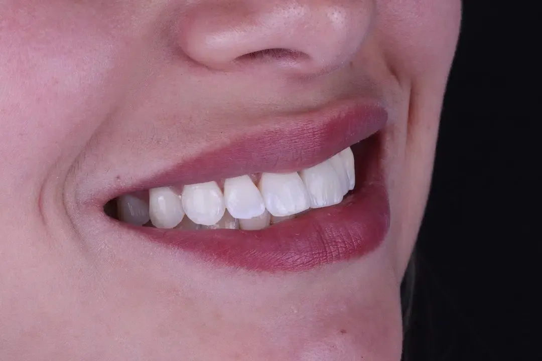 Sorriso com lentes de contato dental de porcelana